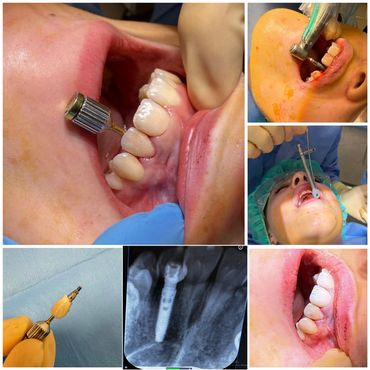 Xla,implant  Bone graft, immediate temporary crown