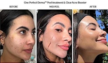 Before, during, and after photos of acne peel treatment showing clear skin improvement.