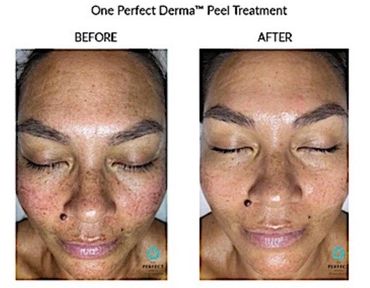 Before and after images showing skin improvement after One Perfect Derma Peel Treatment.