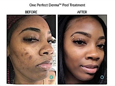 Before and after images showing clear skin improvement after One Perfect Derma Peel Treatment.