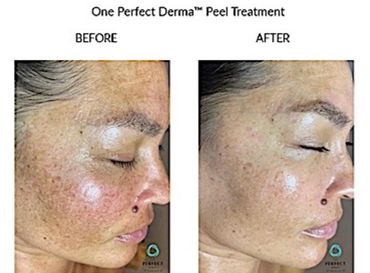 Before and after results of One Perfect Derma Peel treatment showing clearer skin.
