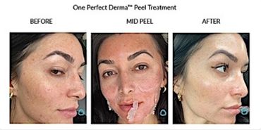 Before, during, and after results of a Perfect Derma peel treatment on a woman's face.