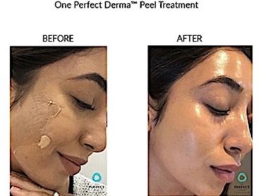 Before and after images showing improved skin texture from One Perfect Derma Peel Treatment.