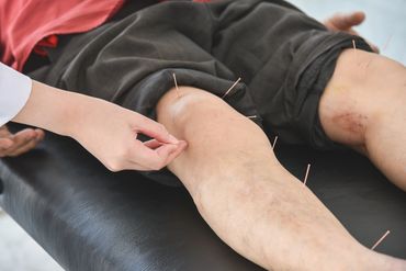 Body Acupuncture, acupuncture, needle
