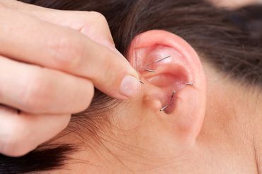 Auricular Acupuncture, acupuncture
