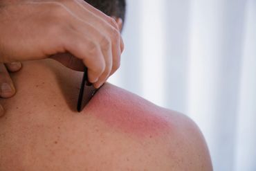 Gua Sha, acupuncture