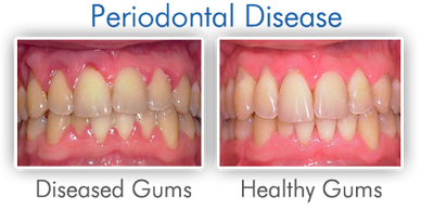 Periodontal Disease