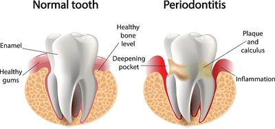Gum Health diagram