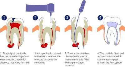 Root Canal diagram