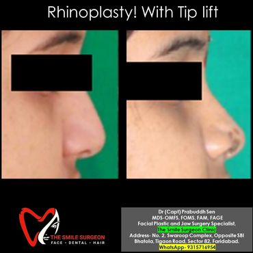 Rhinoplasty in Faridabad, Nose Surgery in Faridabad is done under local anesthesia 