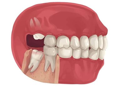 wisdom tooth removal cost faridabad