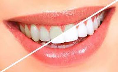 laser teeth whitening faridabad
tooth whitening cost faridabad