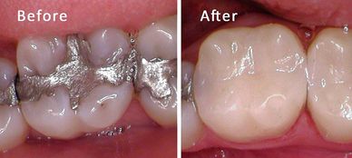 Patient had decay around existing silver fillings and were replaced with white composite fillings.