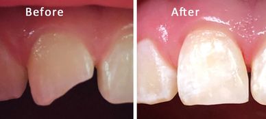 photo of patient's fractured tooth. The tooth was restored with a white composite filling.