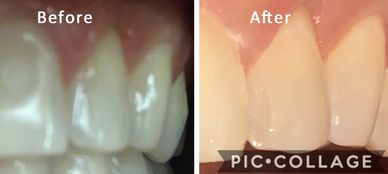 Sensitive and 'gray' teeth from grinding and acid reflux. Restored with white composite veneers.