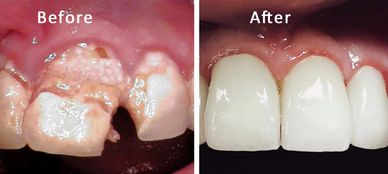Patient had severe decay of their front teeth which were restored with zirconia crowns.