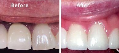 Patient unhappy with natural teeth. Esthetic smile created using porcelain crowns and bridge work.