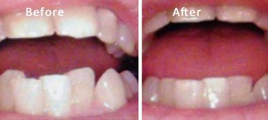 Patient had crowded lower teeth. Reshaped teeth with light sanding. No expensive braces or crowns.