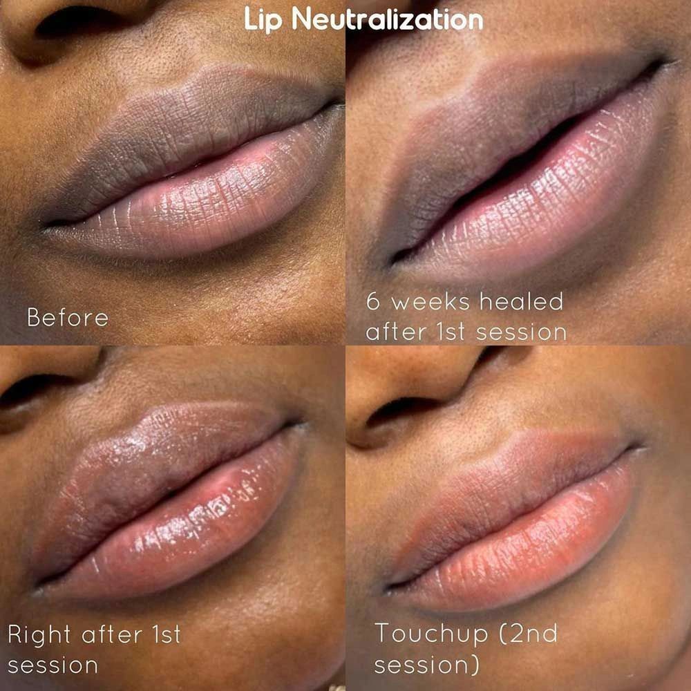 lip neutralization in charlotte nc