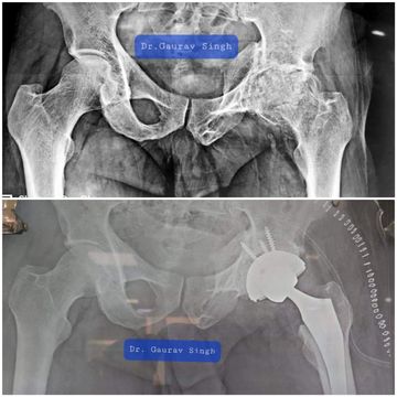 Total Hip Replacement