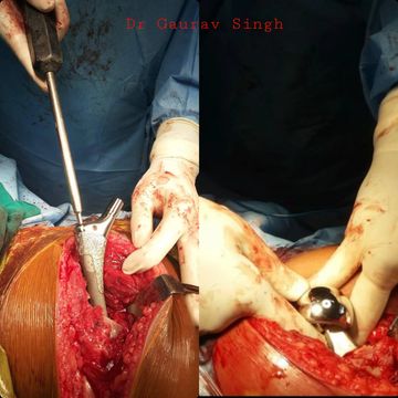 Total Hip replacement  Dr Gaurav Singh