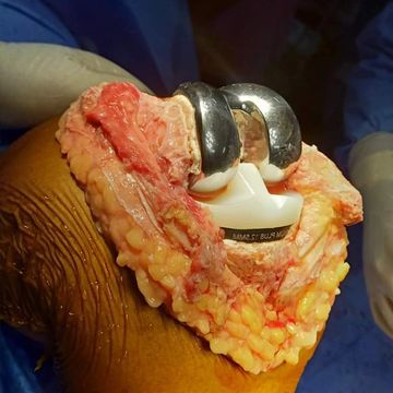 Total knee replacement by dr gaurav