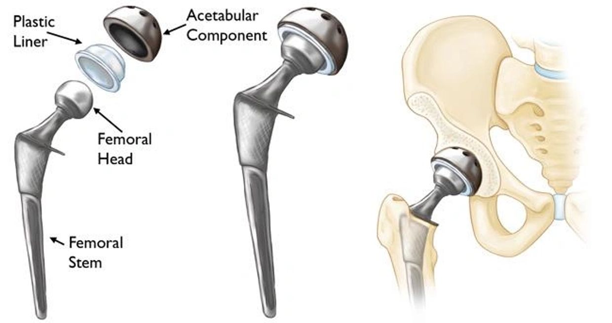 total hip replacement