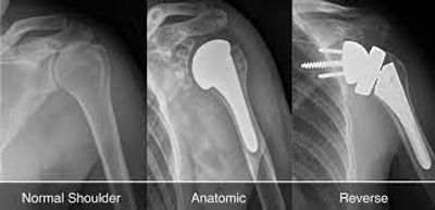shoulder replacement