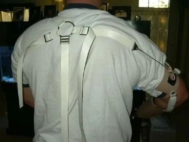 Custom prosthetic arm fitting on a person