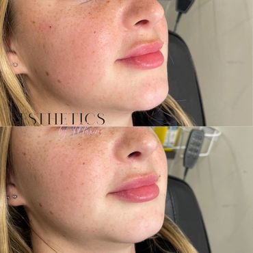 best botox near me bondi