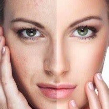 microdermabrasion, skin resurfacing, anti aging, pigmentation, acne scarring