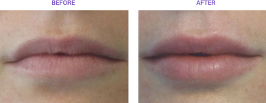 Lip augmentation