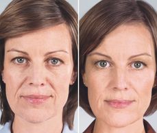 Fillers for facial lines and wrinkles