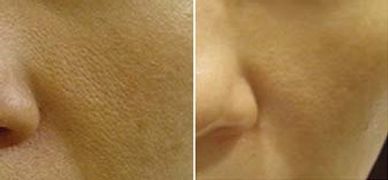 Microneedling large pores