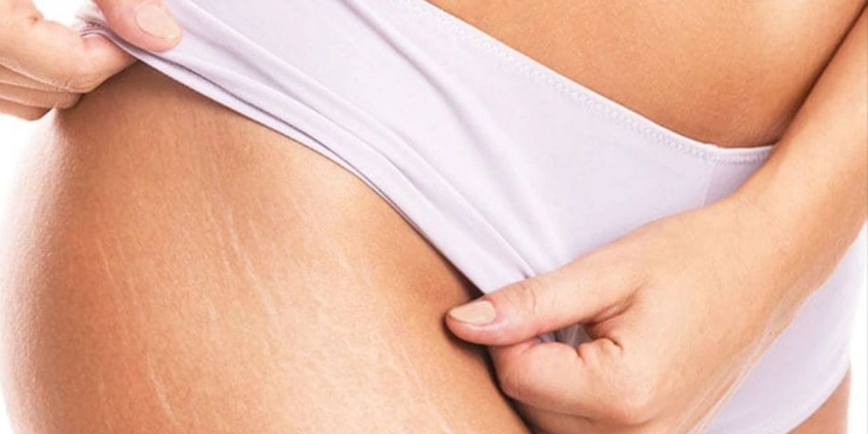 stretch marks, fat, thick thighs, diet, fat loss, weight loss, newmarket, bradford