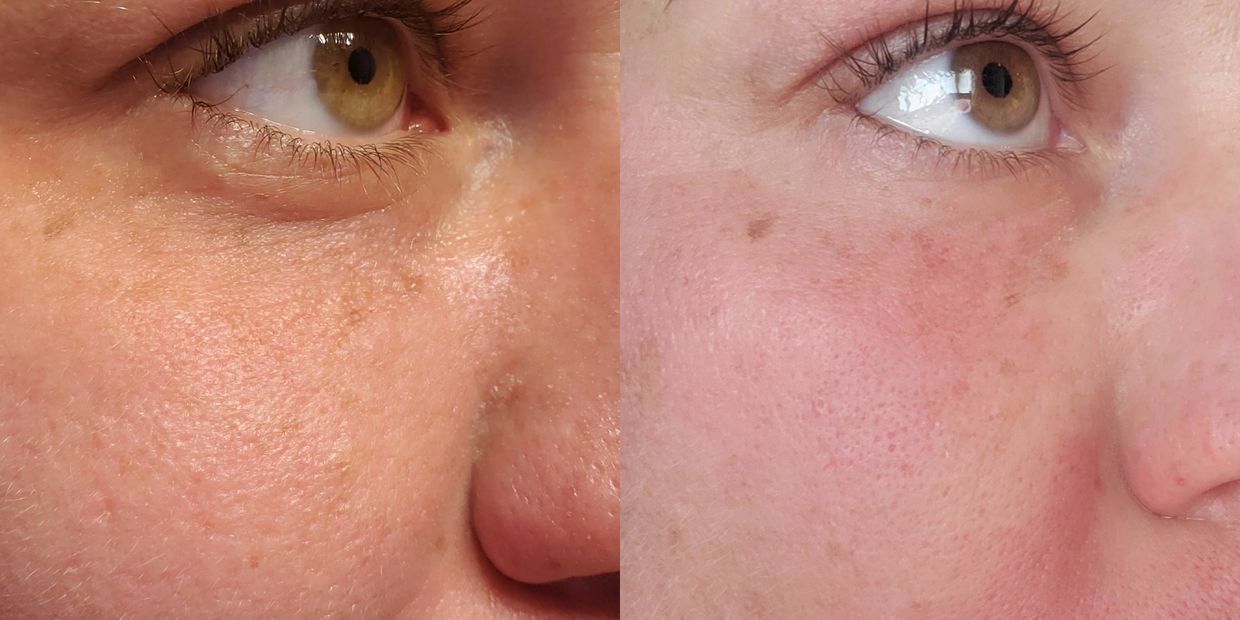 under eye bags, younger, no wrinkles, newmarket