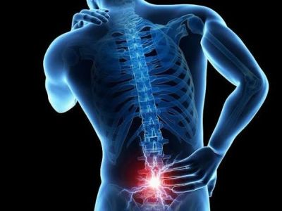 Sciatica and lower back pain illustration showing nerve irritation in the lumbar spine