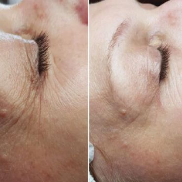 Polynucleotides before and after results