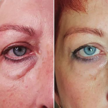 Polynucleotides before and after results