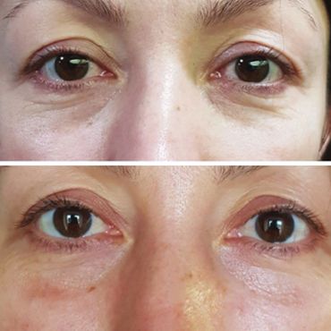 Polynucleotides before and after results