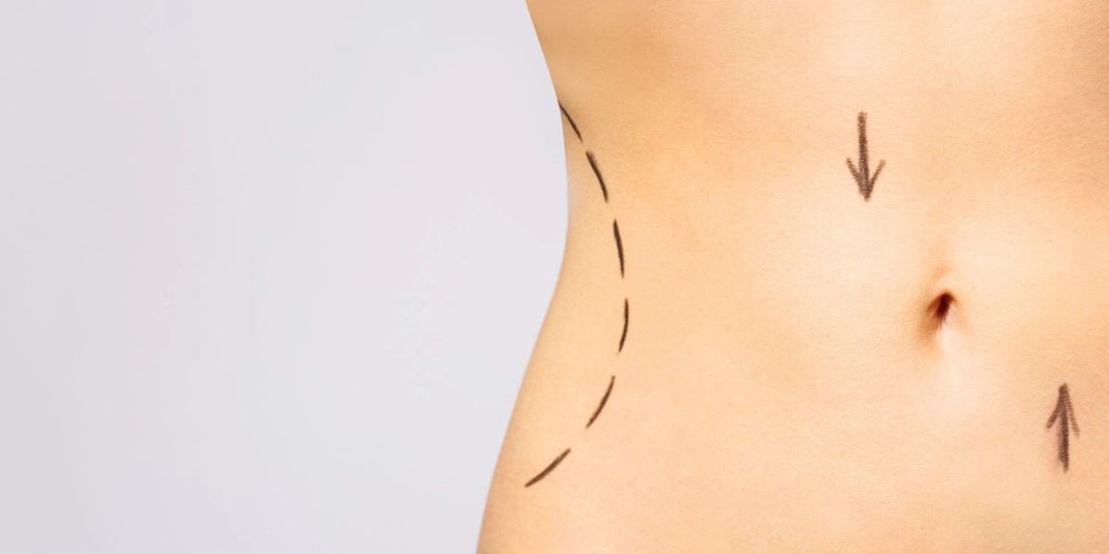 Laser Liposuction utilizes the latest low level/cold laser technology to reduce girth and fat over a