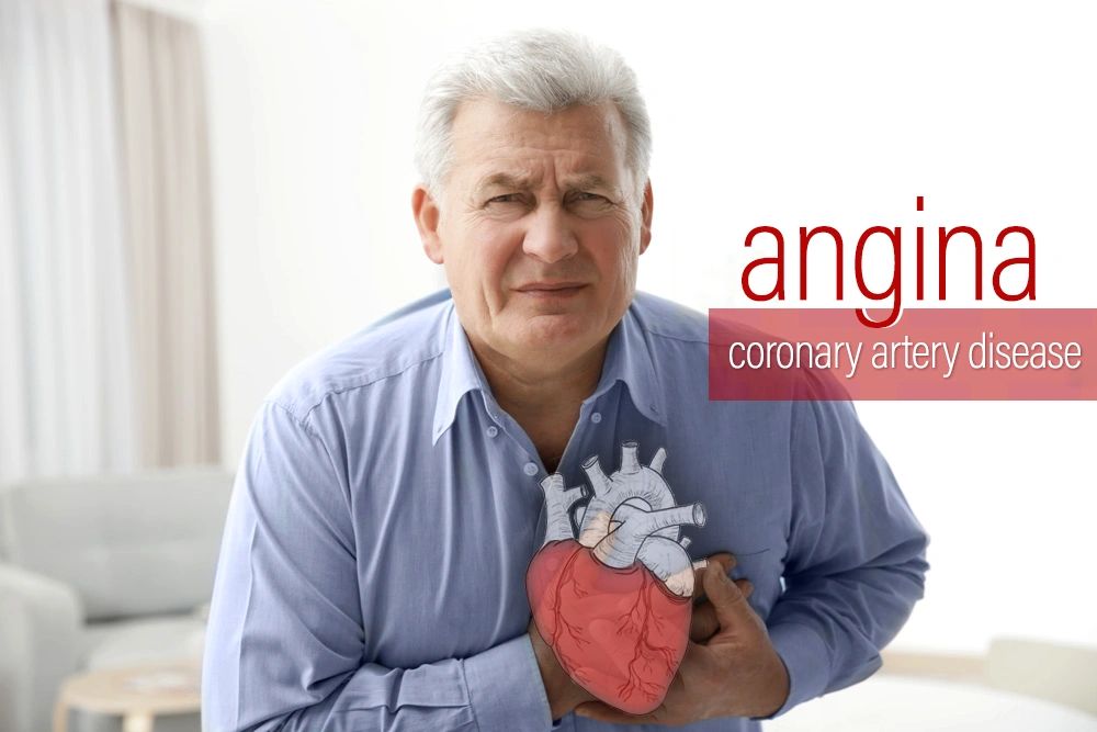 Nitrolingual® Pumpspray is indicated for acute relief of attack or prophylaxis of angina pectoris.