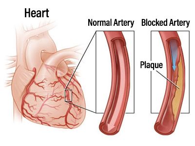 Nitrolingual® Pumpspray is indicated for acute relief of attack or prophylaxis of angina pectoris.