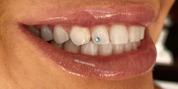 Tooth gem services with Official Pro Smiles in Phoenix Az.
