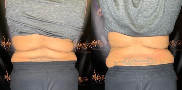 Laser lipo targeting back rolls.