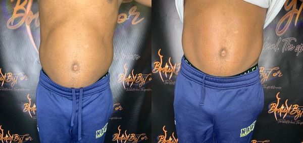 Laser lipo.