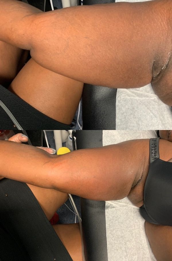 Skin tightening before (top) and after (bottom).