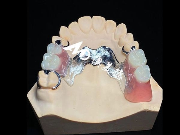 Dental partial denture on a dental mold.