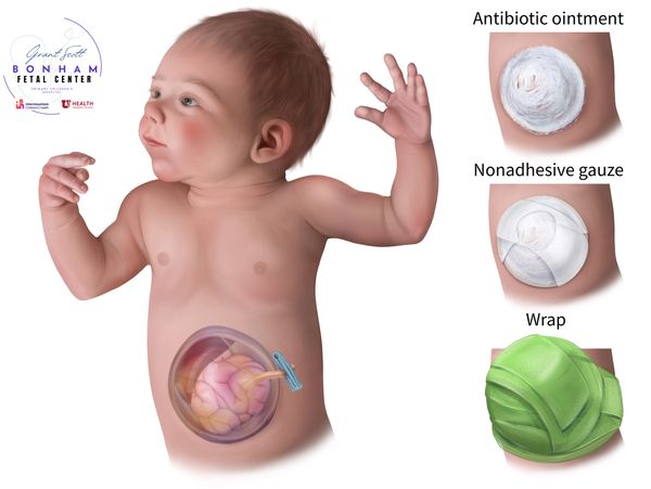Child with omphalocele treated at the Grant Scott Bonham Fetal Center at Primary Childrens Hospital