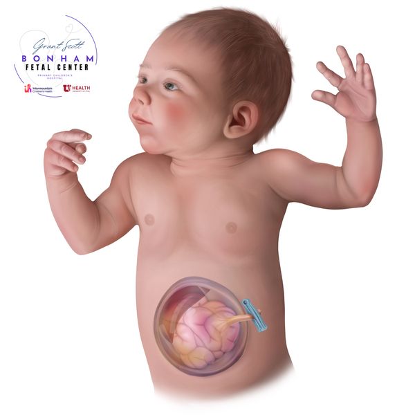 Child with omphalocele treated at the Grant Scott Bonham Fetal Center at Primary Childrens Hospital